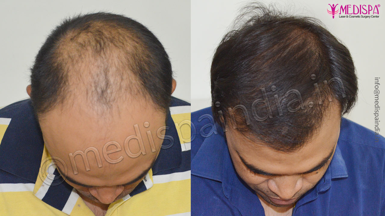 top hair transplant surgeons in jaipur india