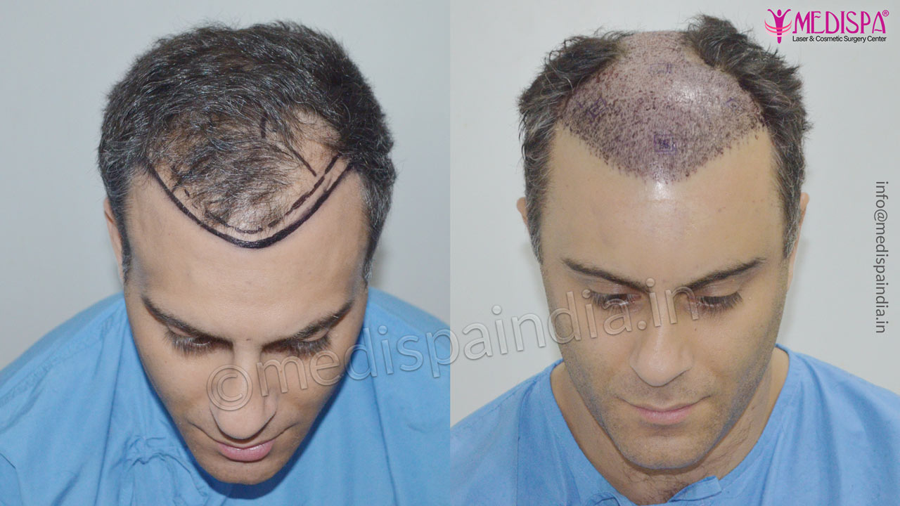 uk hair transplant before after