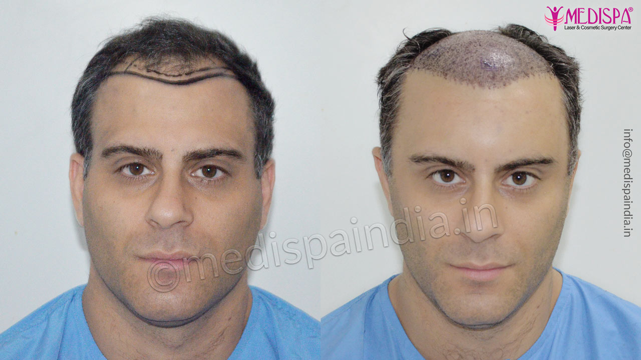 uk hair transplant results
