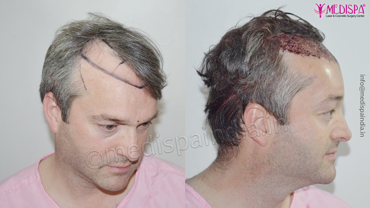 uk hair transplant results