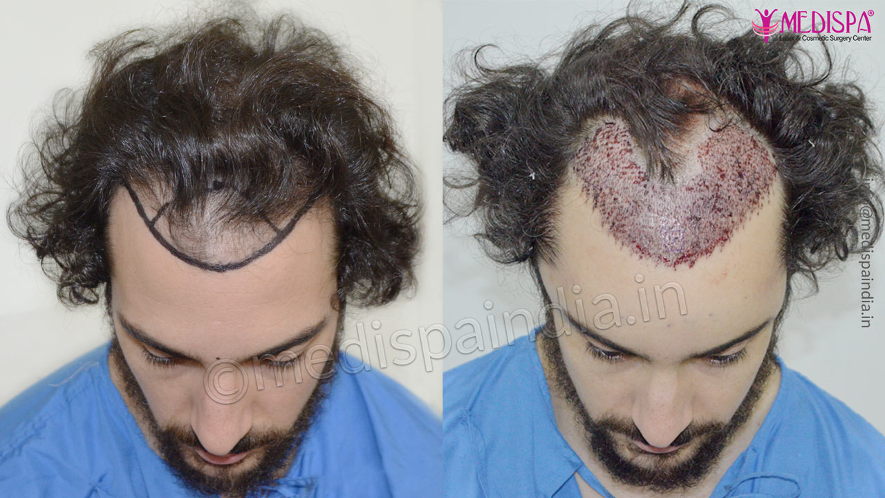 usa hair restoration patient result