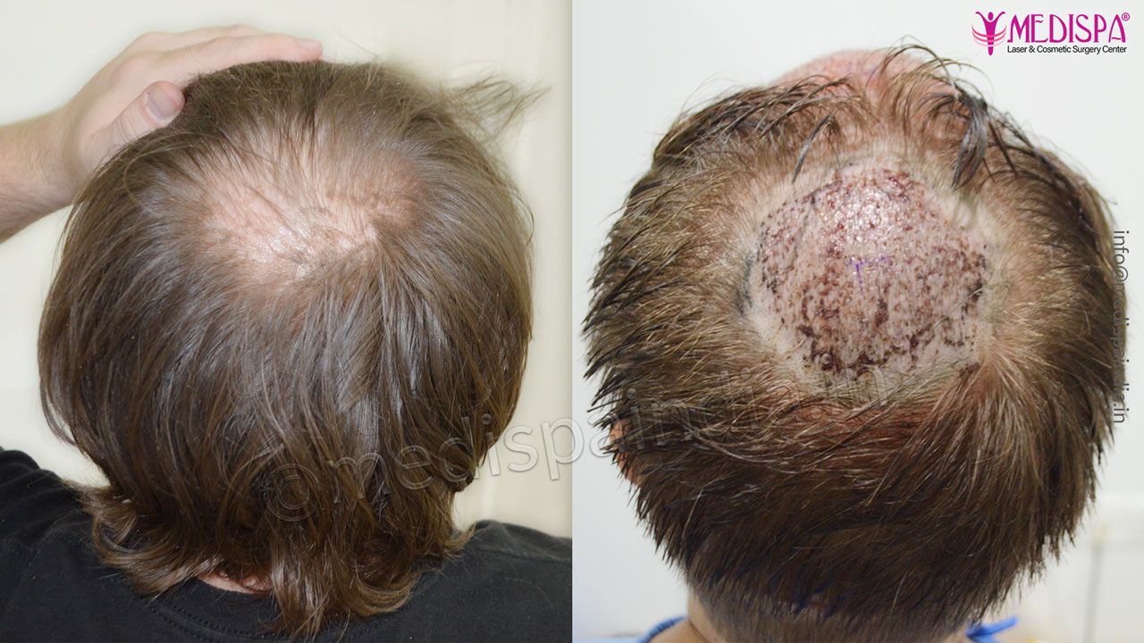 usa hair transplant results