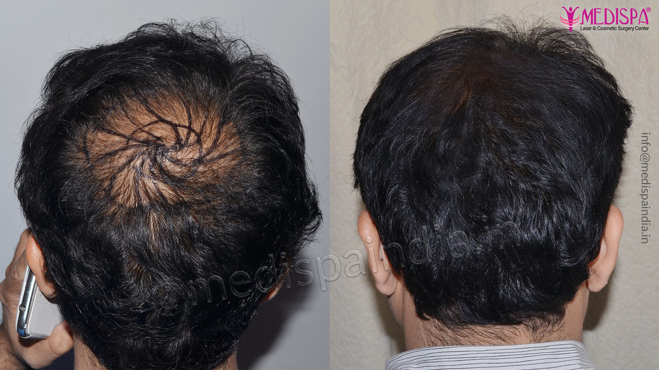 Crown Hair Transplant Before After Results at Medispa India Crown Hair Transplant Before After Results at Medispa India
