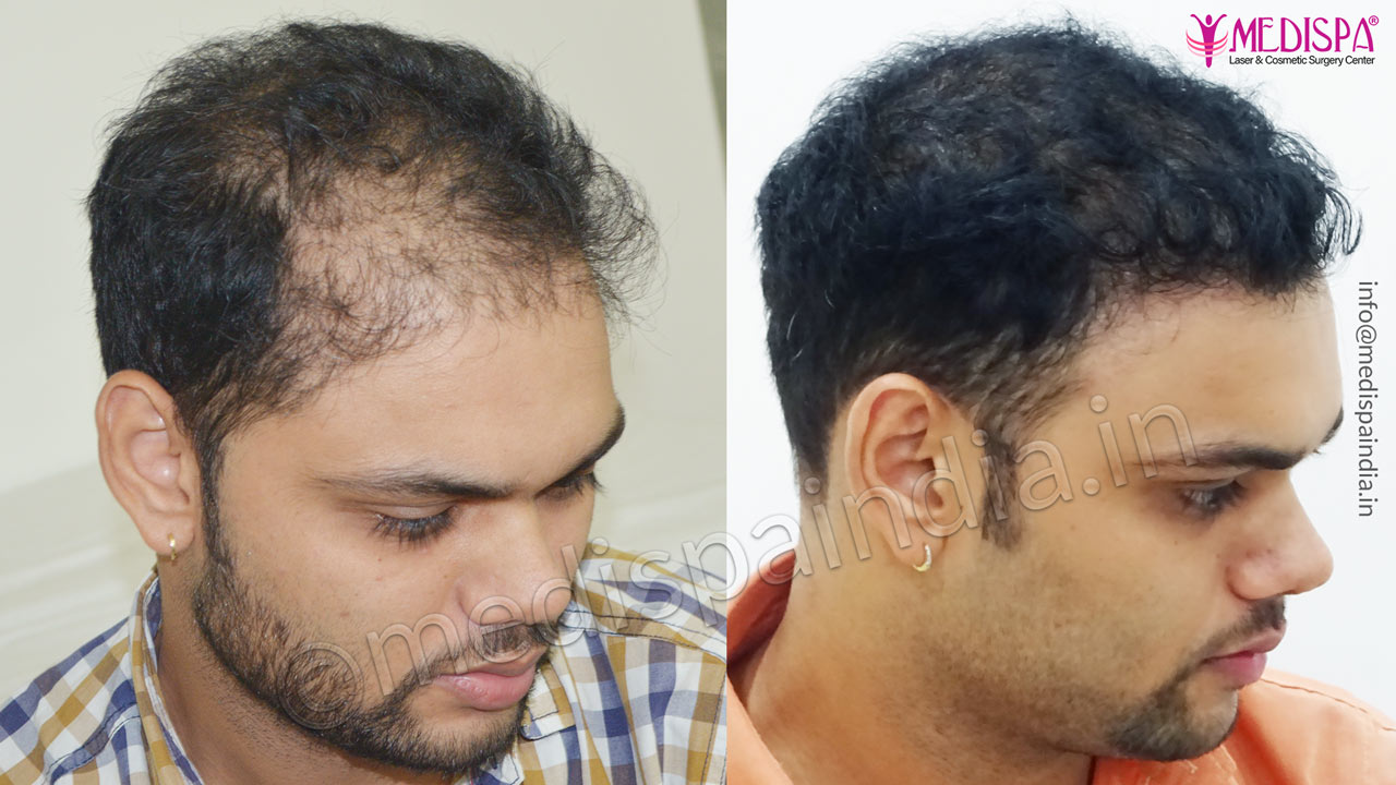 wrong hair transplant correction bangalore