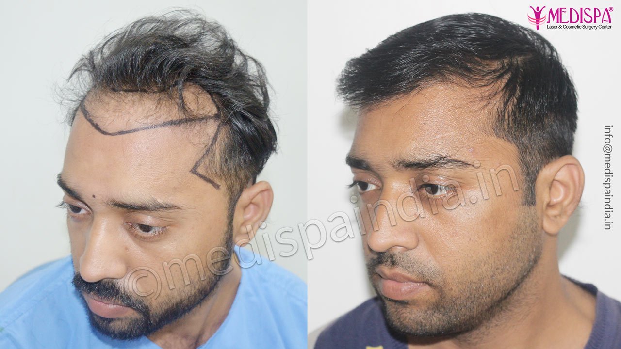 wrong hair transplant correction in delhi