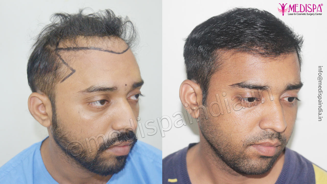 wrong hair transplant correction in jaipur