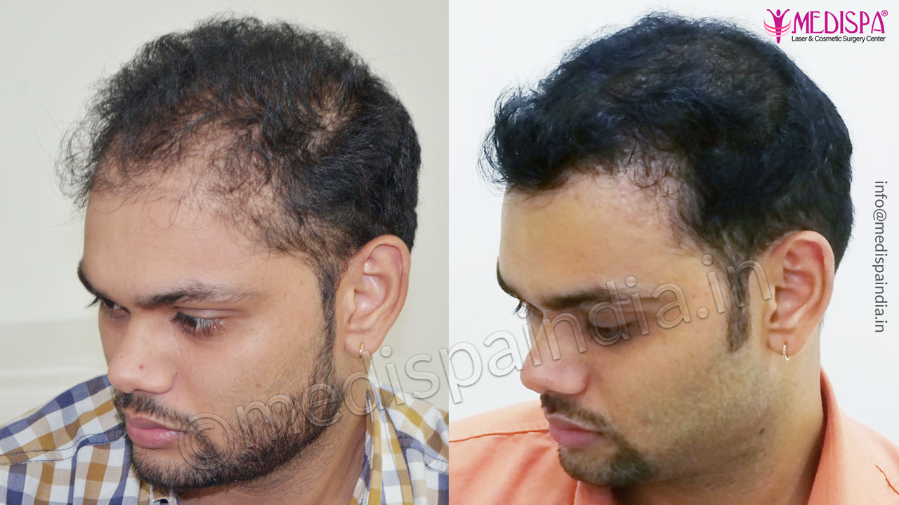 wrong hair transplant correction mumbai