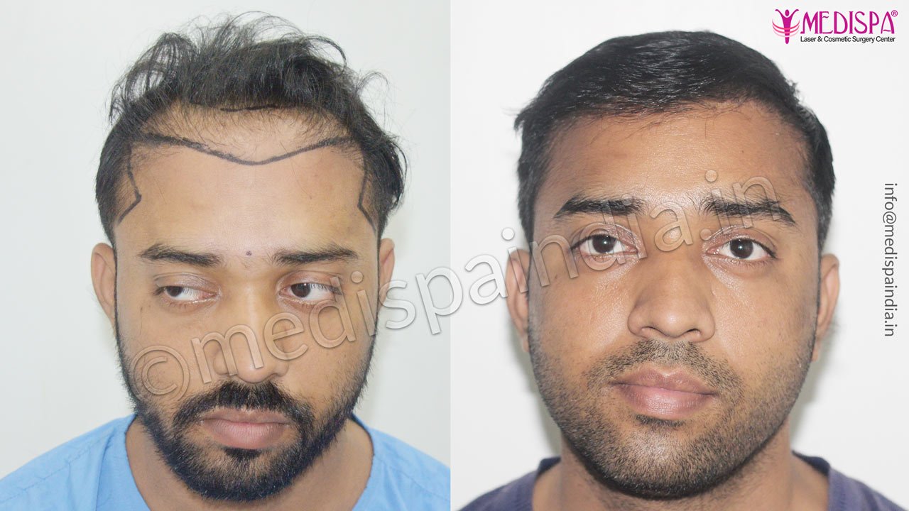 wrong hair transplant correction pune