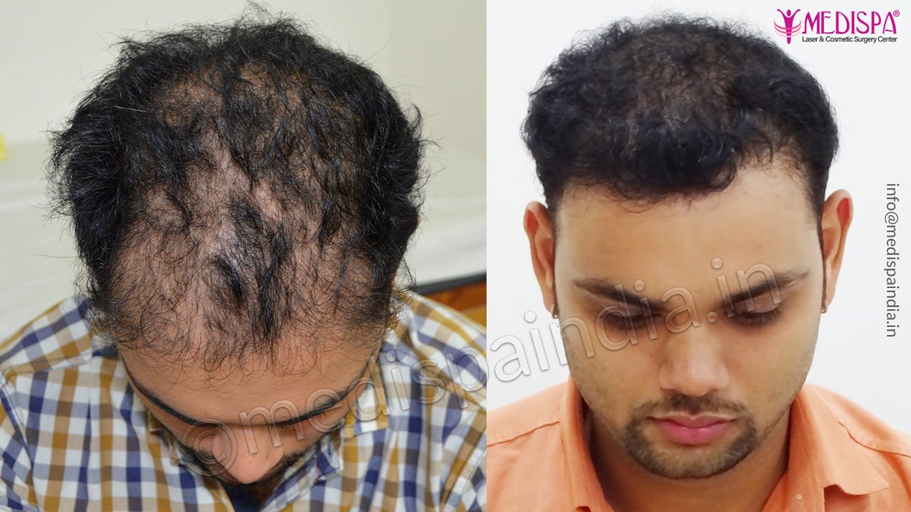 wrong hair transplant correction pune