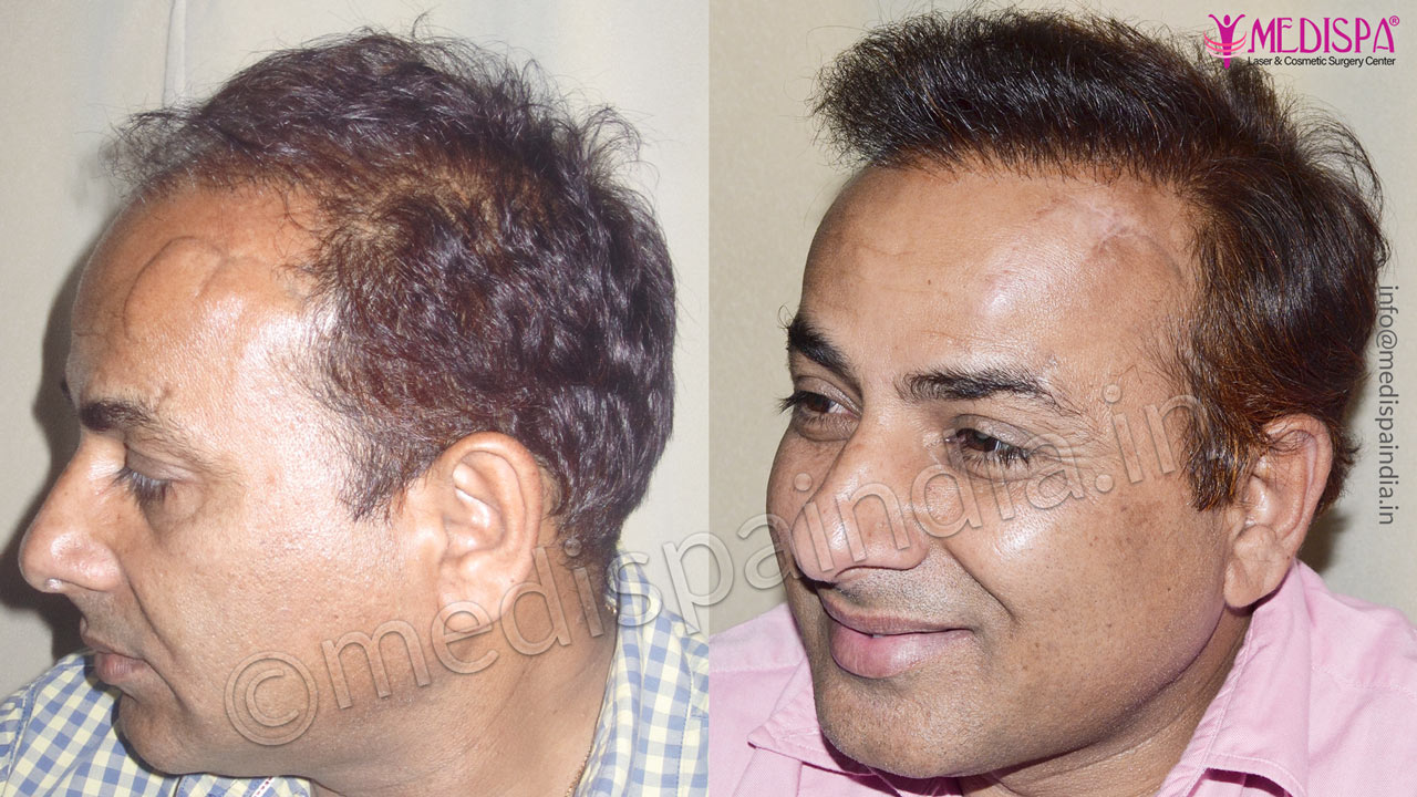 wrong hair transplant results at medispa