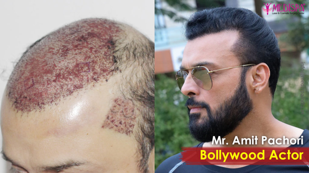 Actor Amit Pachori Hair Transplant Results