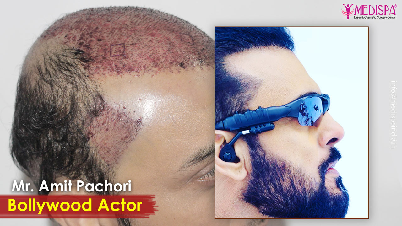 actor hair transplant results india