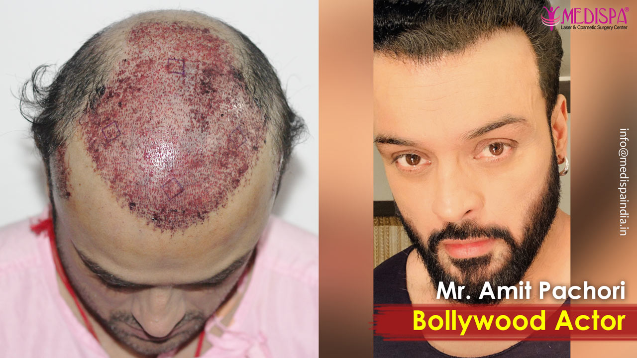 bollywood actor hair transplant india