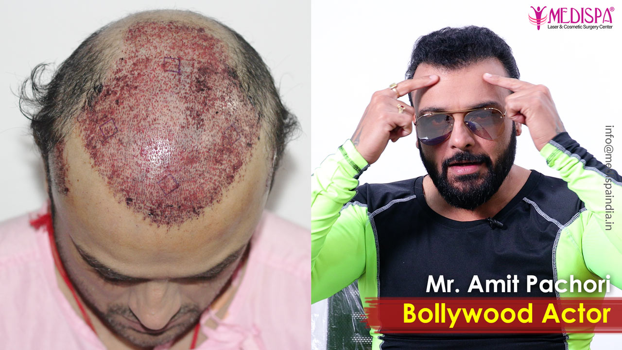 celebrity hair transplant rajasthan