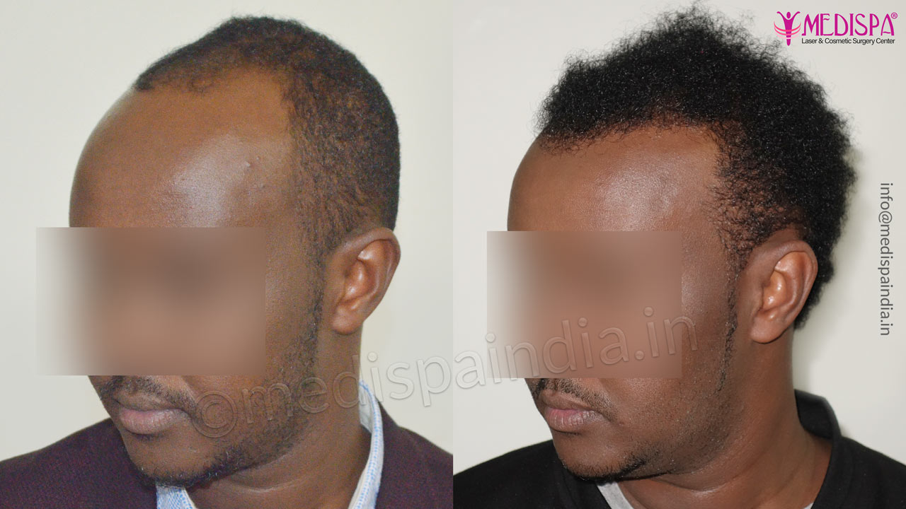 africans hair restoration