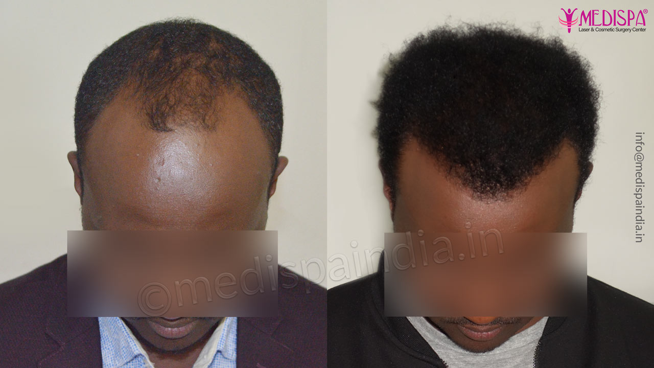 africans hair transplant results