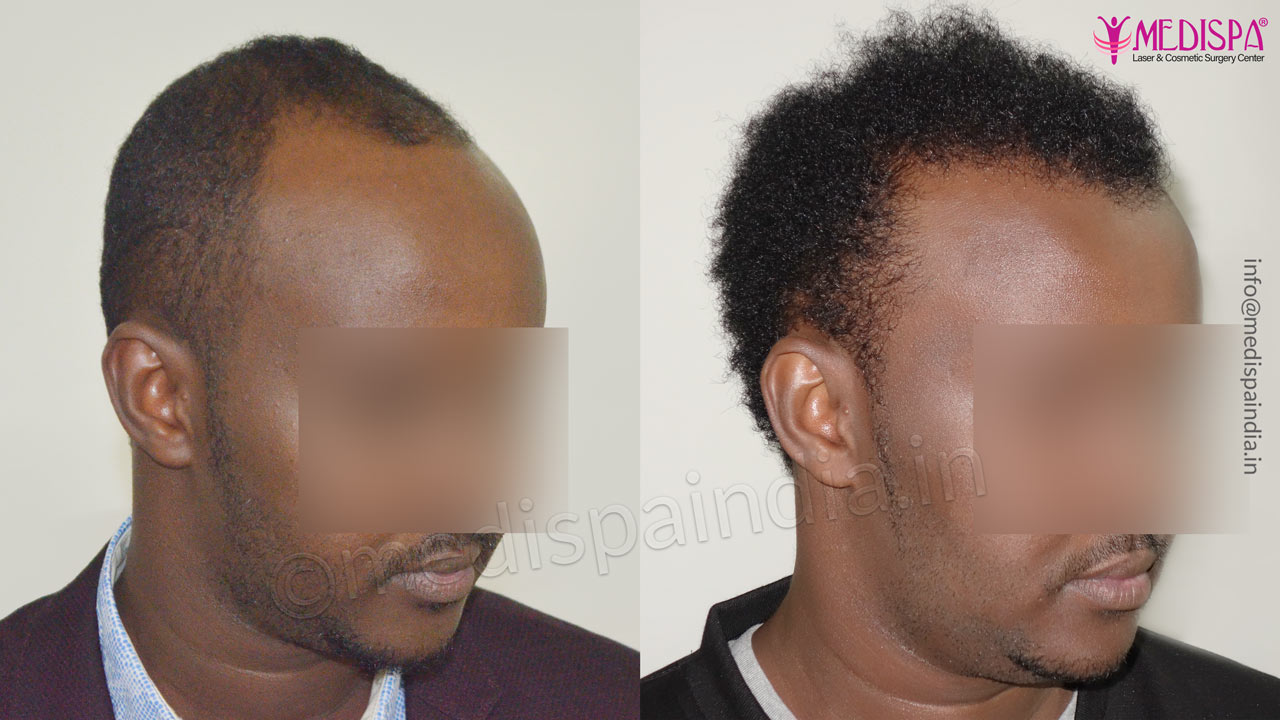 africans hair transplant