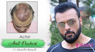 hair transplant in jaipur