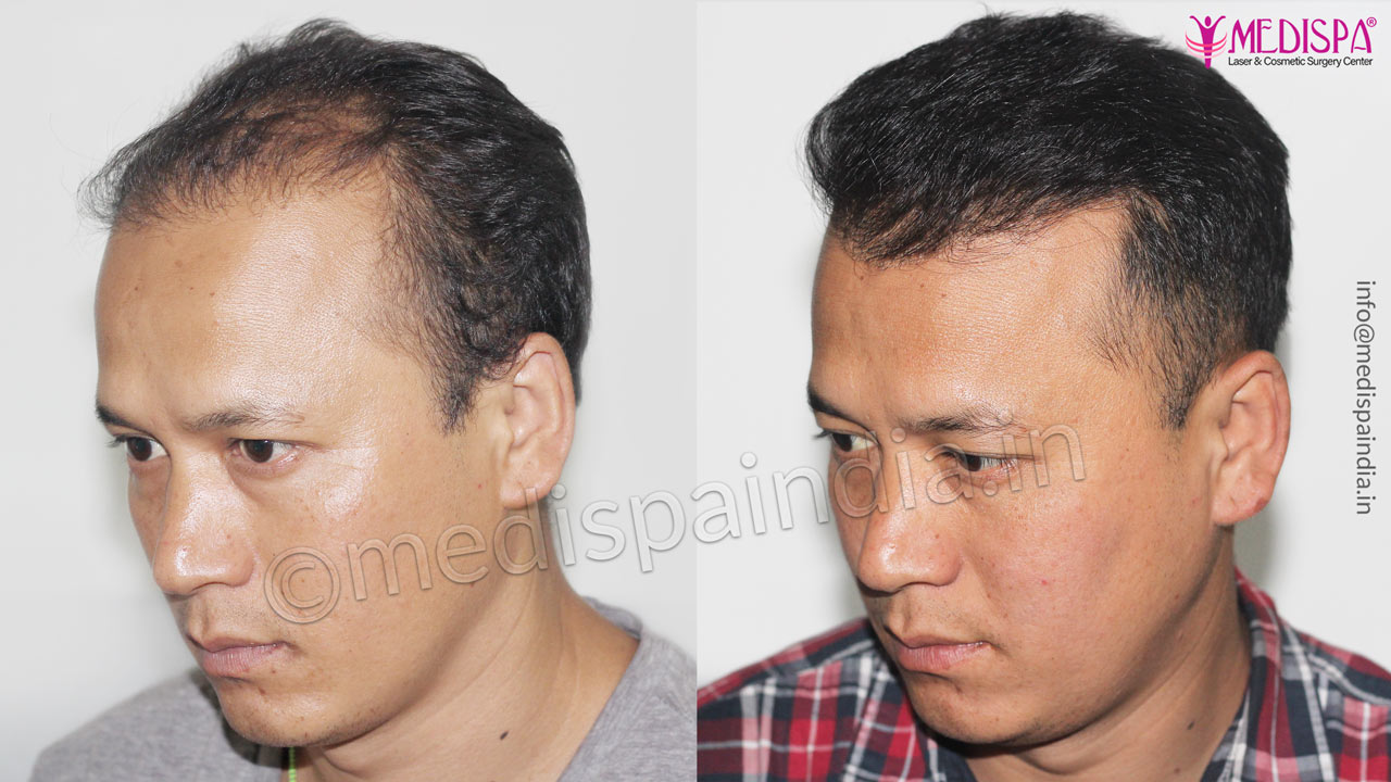 hair transplant results ajmer