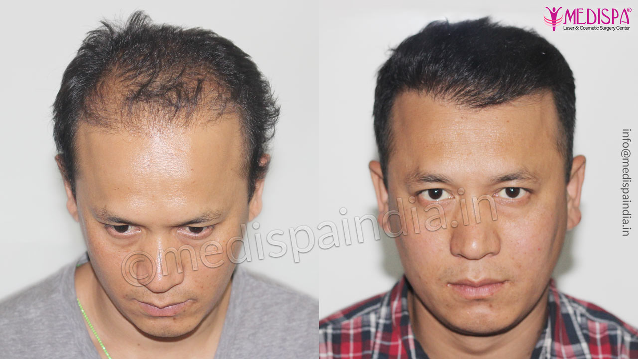 hair transplant-results