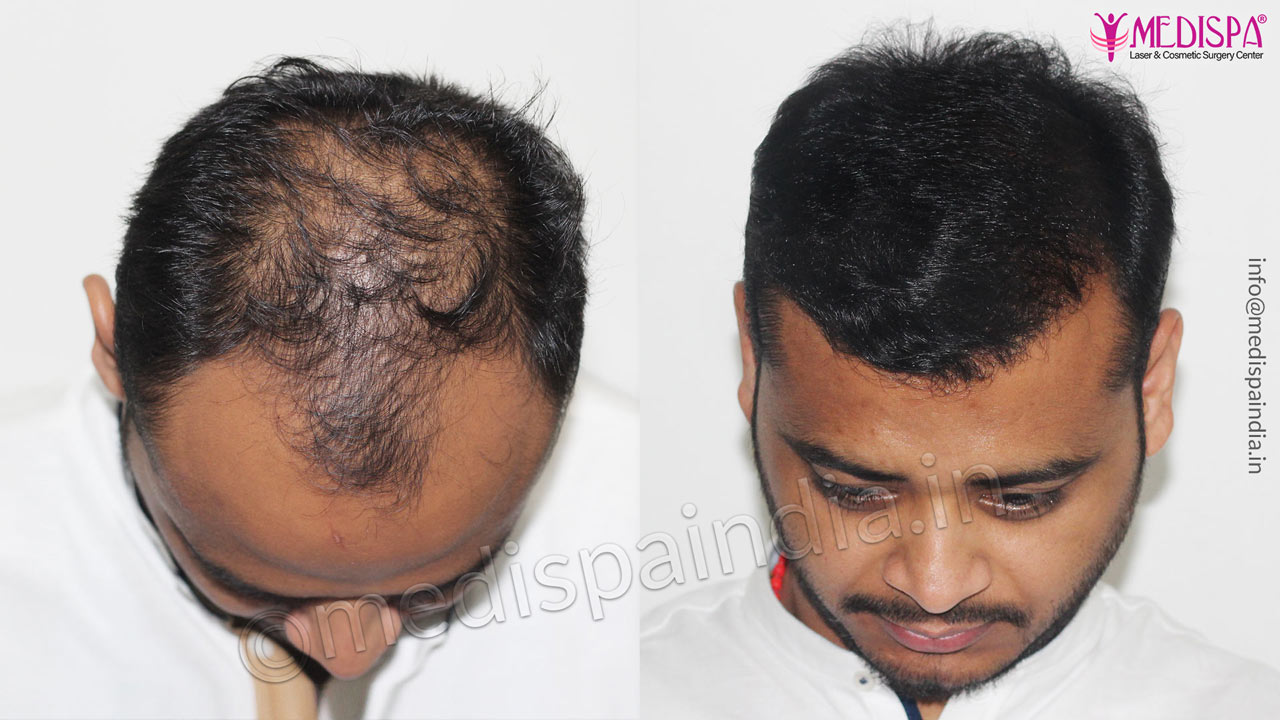 best hair transplant before after results