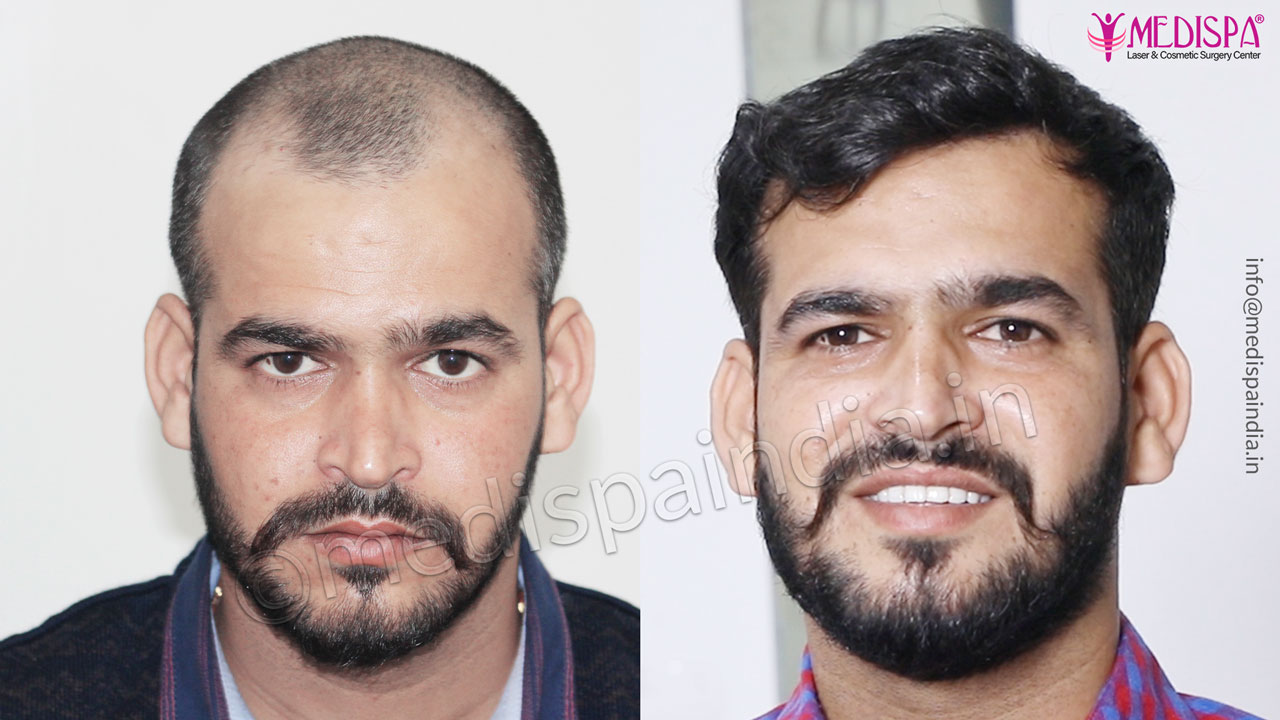 How do we determine the Cost of Hair Transplant in Kolkata 