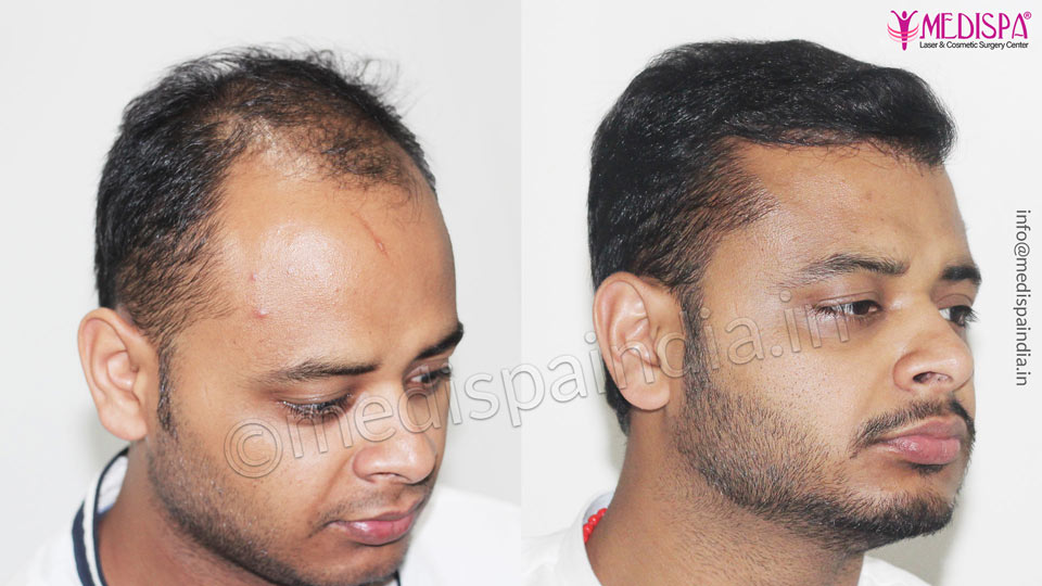 best hair transplant results in india