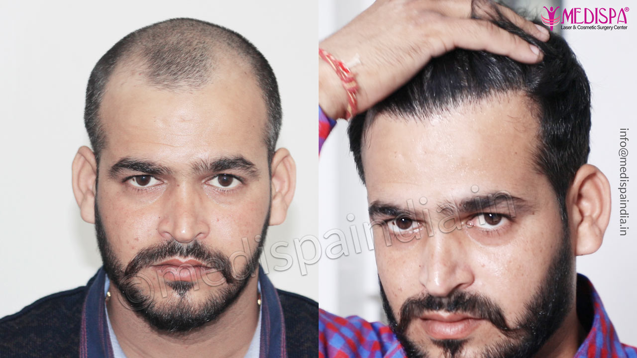hair transplant after results jaipur rajasthan