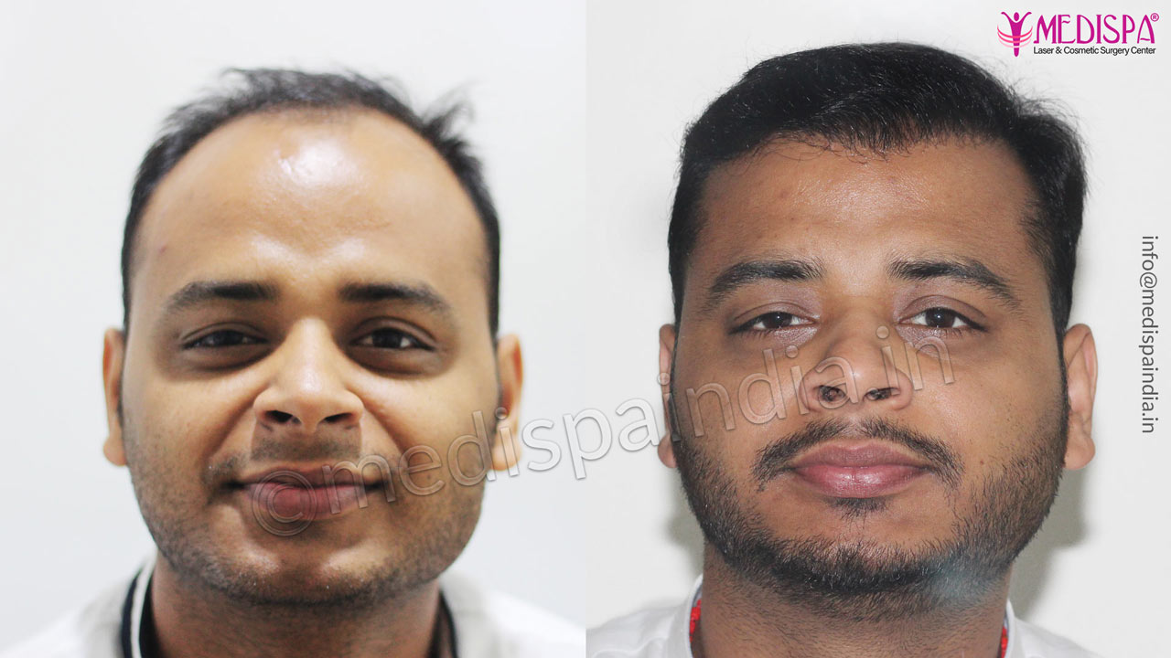 dubai hair transplant result