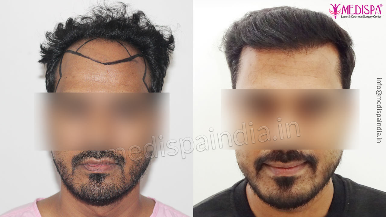 hair transplant Lucknow