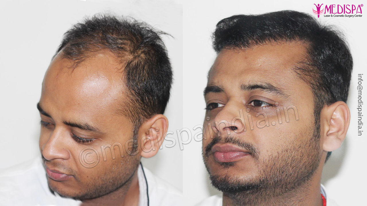 hair transplant results after 12 months