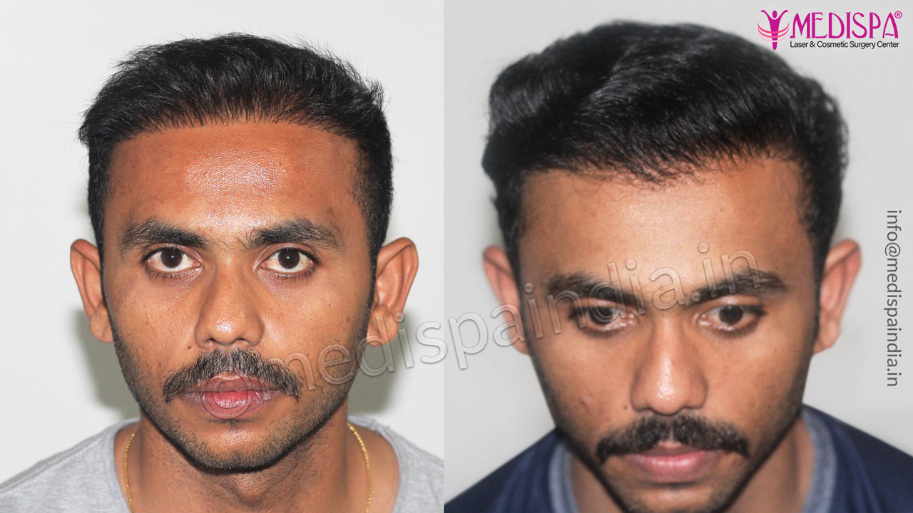 best hair transplant results in jaipur