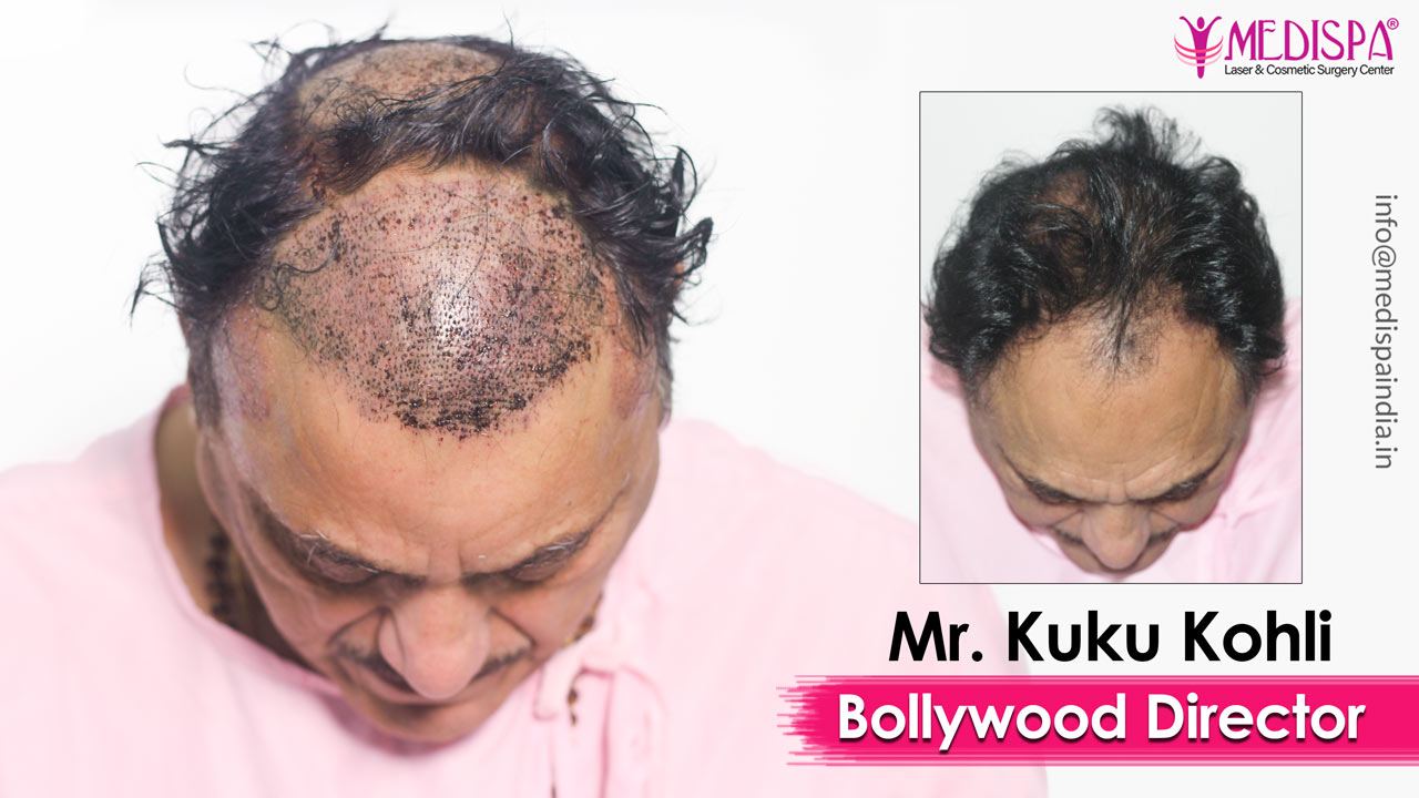 best celebrity hair transplant surgeon india