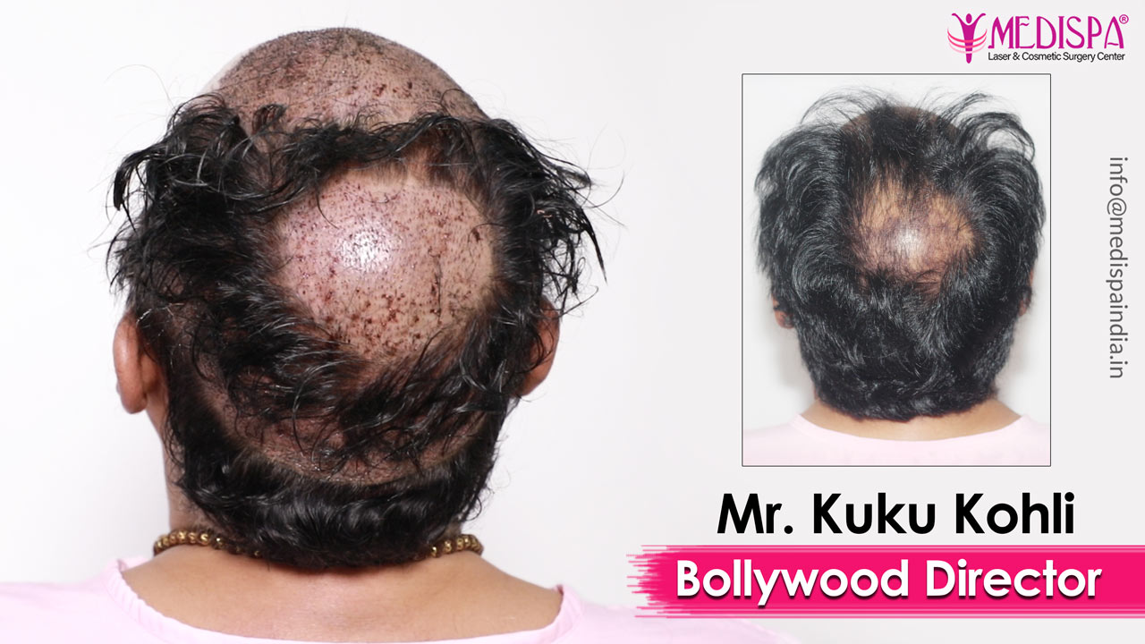 celebrity hair transplant delhi