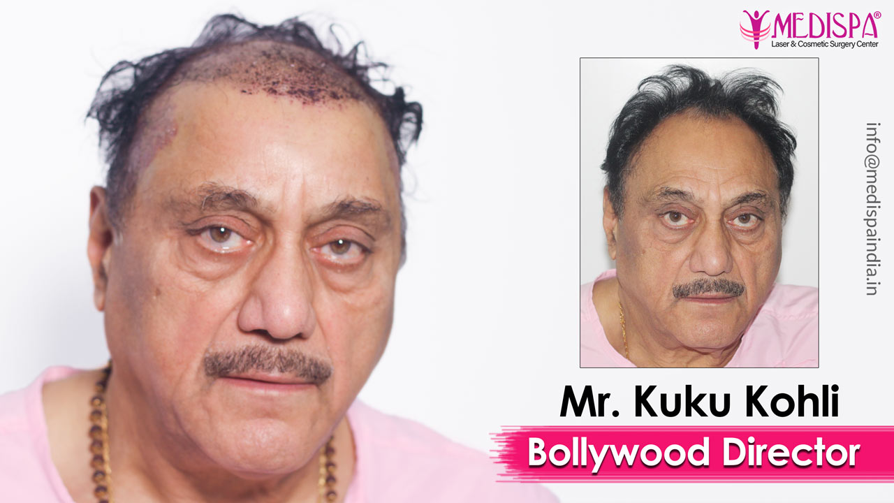 celebrity hair transplant india
