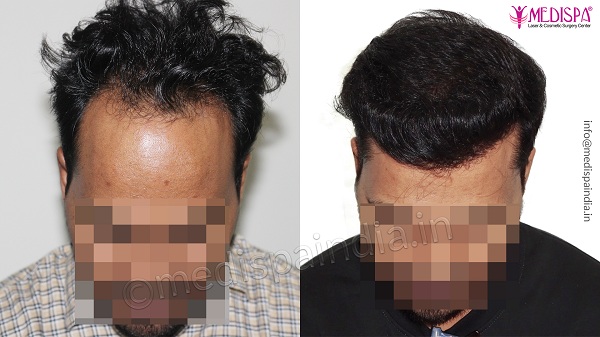 How To Improve Graft Survival Rate In Hair Transplantation?
