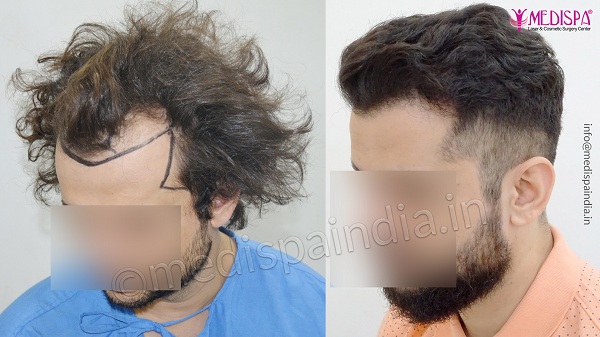 Significant Factors Which Help To Get Cost-Effective Hair Transplant Surgery