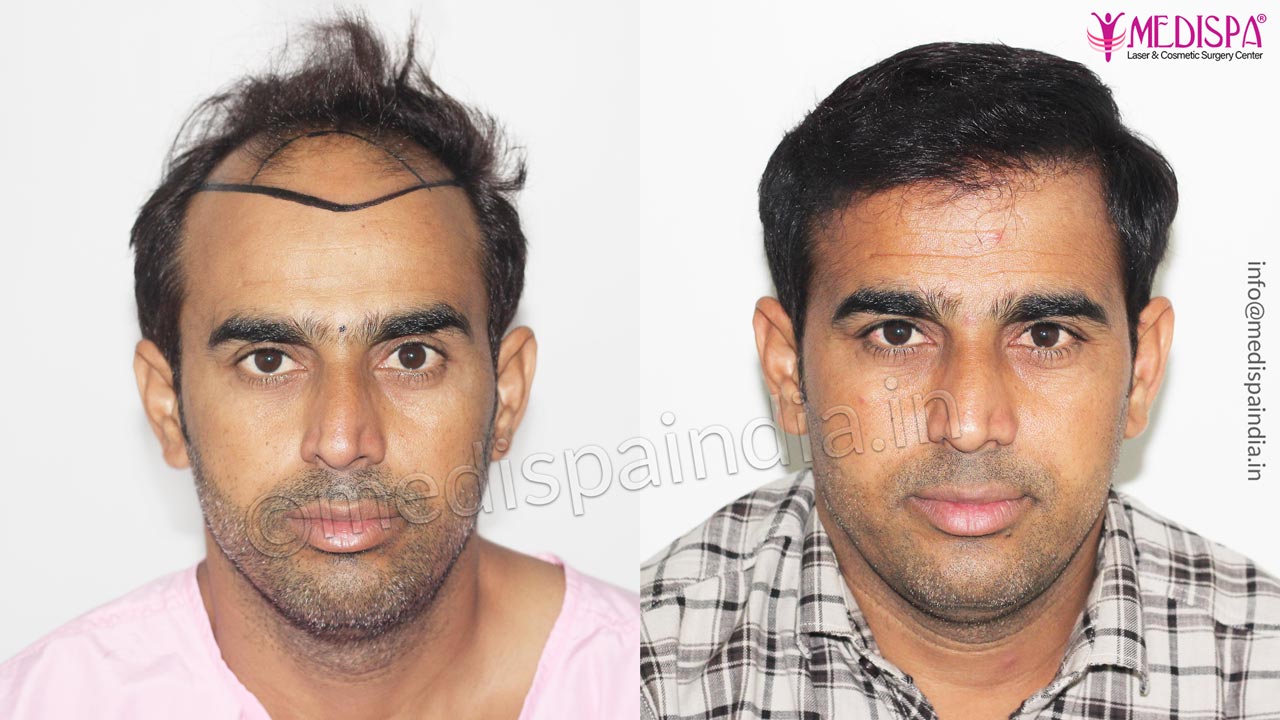 hair transplant result