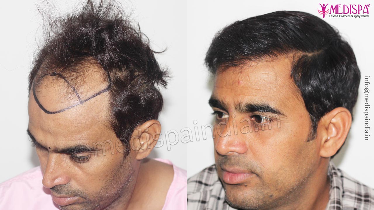 best hair transplant in jaipur rajasthan