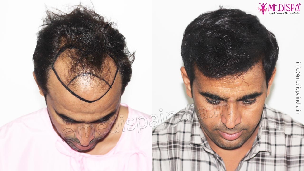 best hair transplant results in jaipur