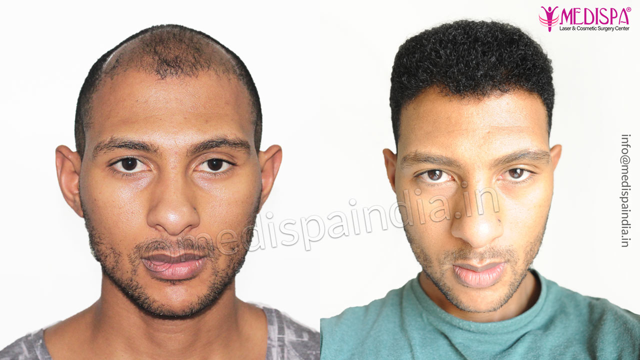 hair transplant cost in south africa