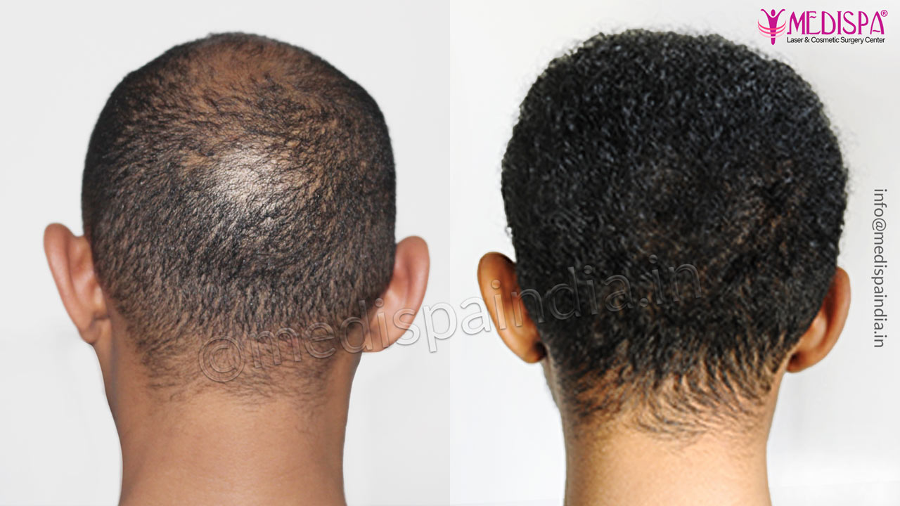 hair transplant before after south african