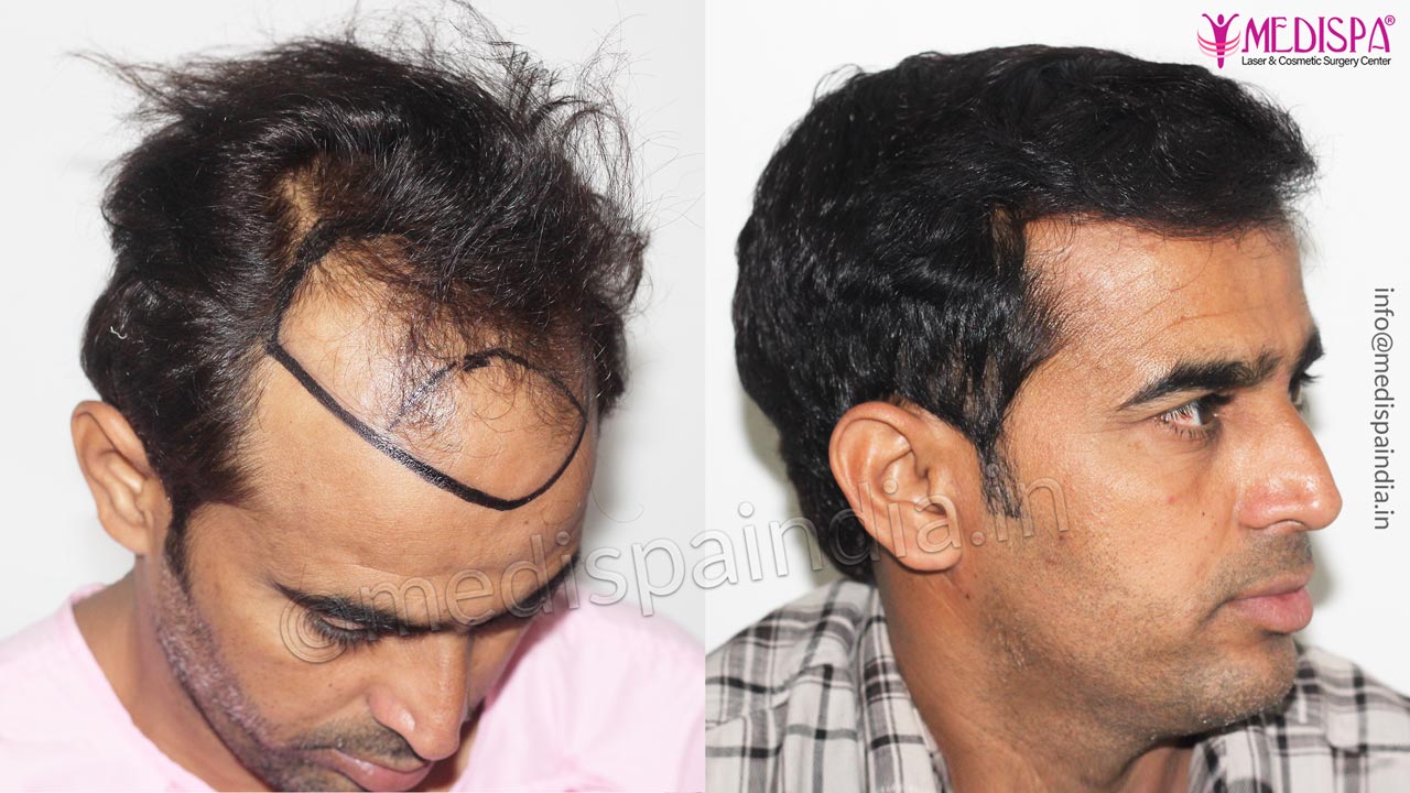 hair transplant cost in jaipur