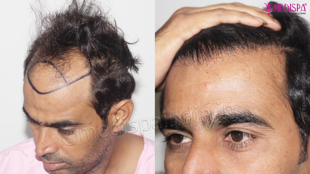hair transplant in bikaner rajasthan