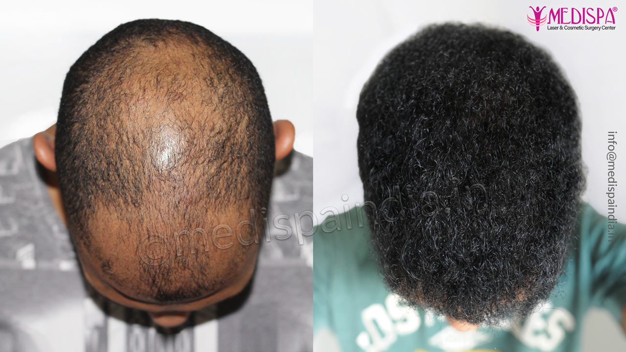 hair transplant in curly hairs