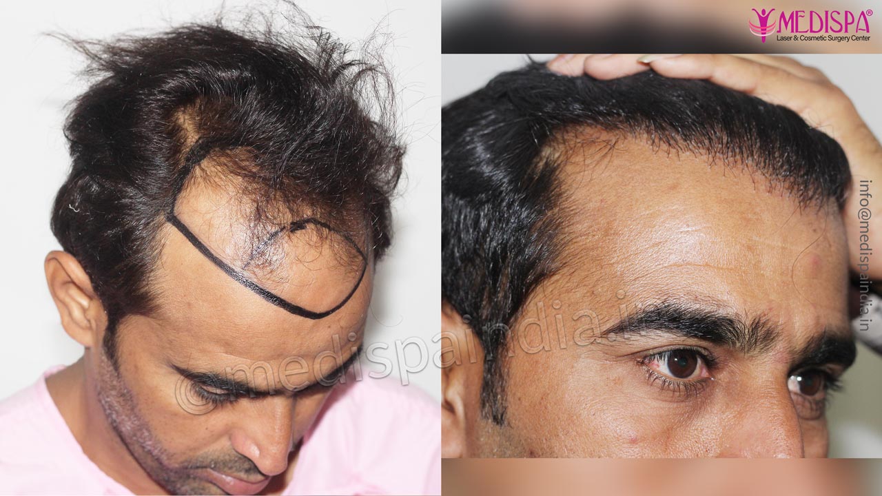 hair transplant results in jaipur india