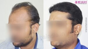 Tips To Research The Best Hair Transplant Clinic In Jaipur