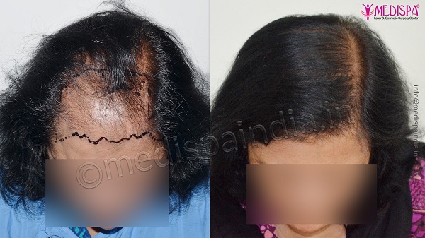 Can Hair Transplantation Cure Female Pattern Baldness