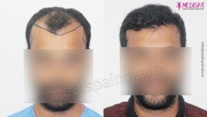 Is It Possible To Get Painless Hair Restoration Surgery With Maximum Results?