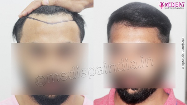 How to overcome male pattern baldness by hair restoration?